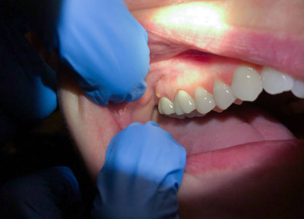 Best Emergency Root Canal Treatment in Sheboygan Falls, WI